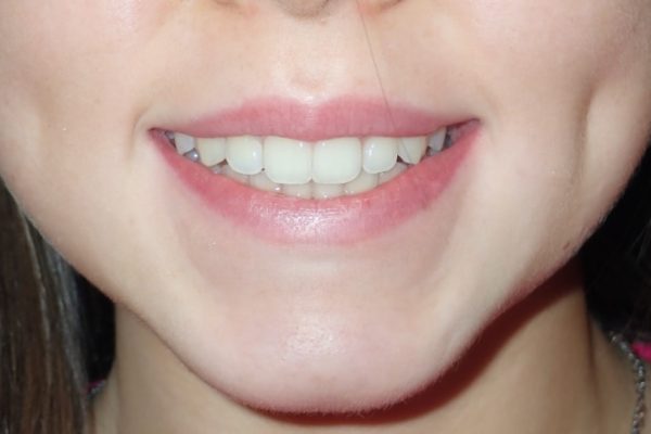 3001Frontal-Final-12